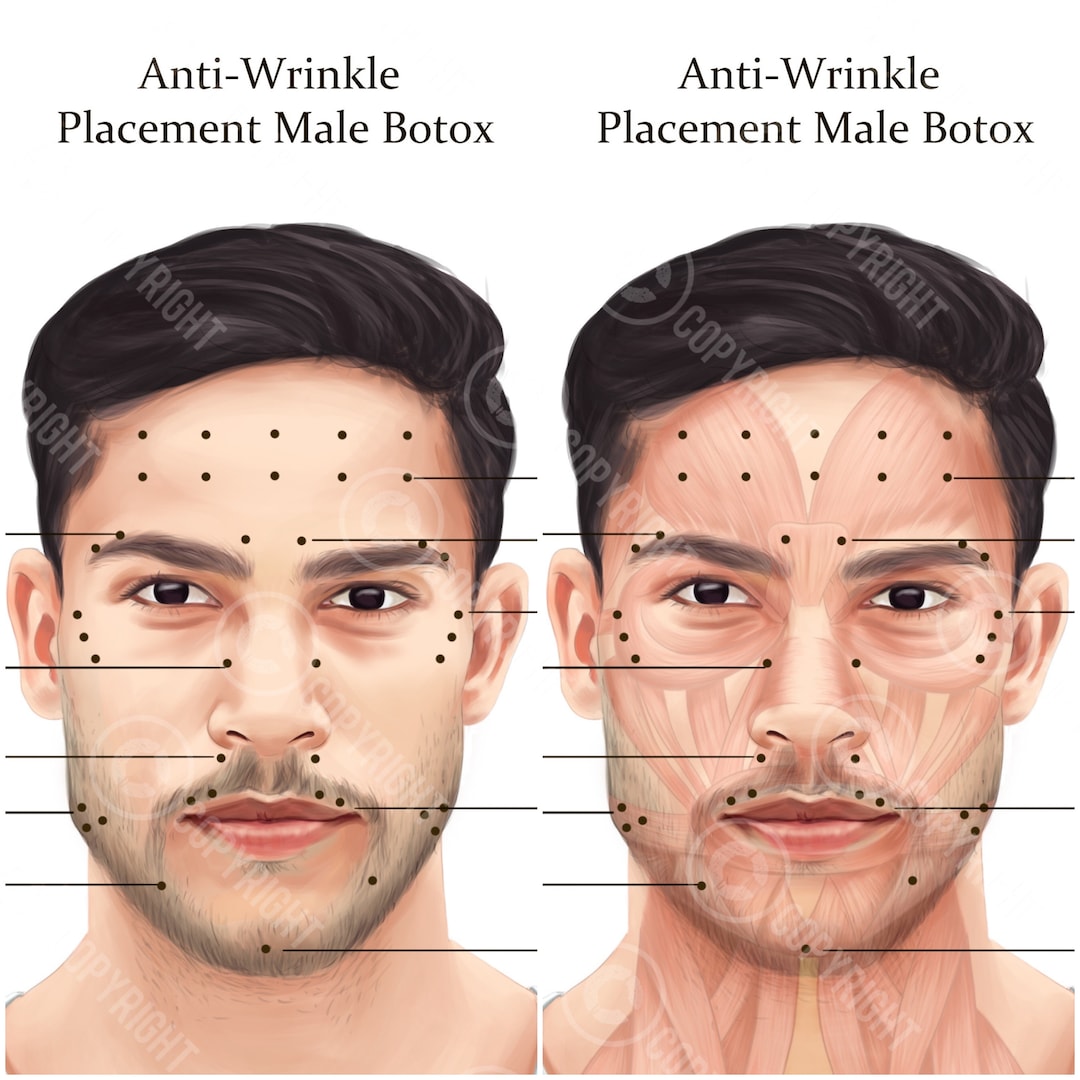 Male BOTOX Injection Points Bundle | Botox & Filler Injector | Anatomy ...