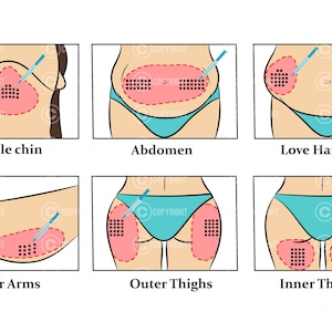 Fat Dissolving injection pattern | Aqualyx | Deso | Lipolab | Botox & Filler | Anatomy | Aesthetics | Dermatology | Medspa| Digital Download