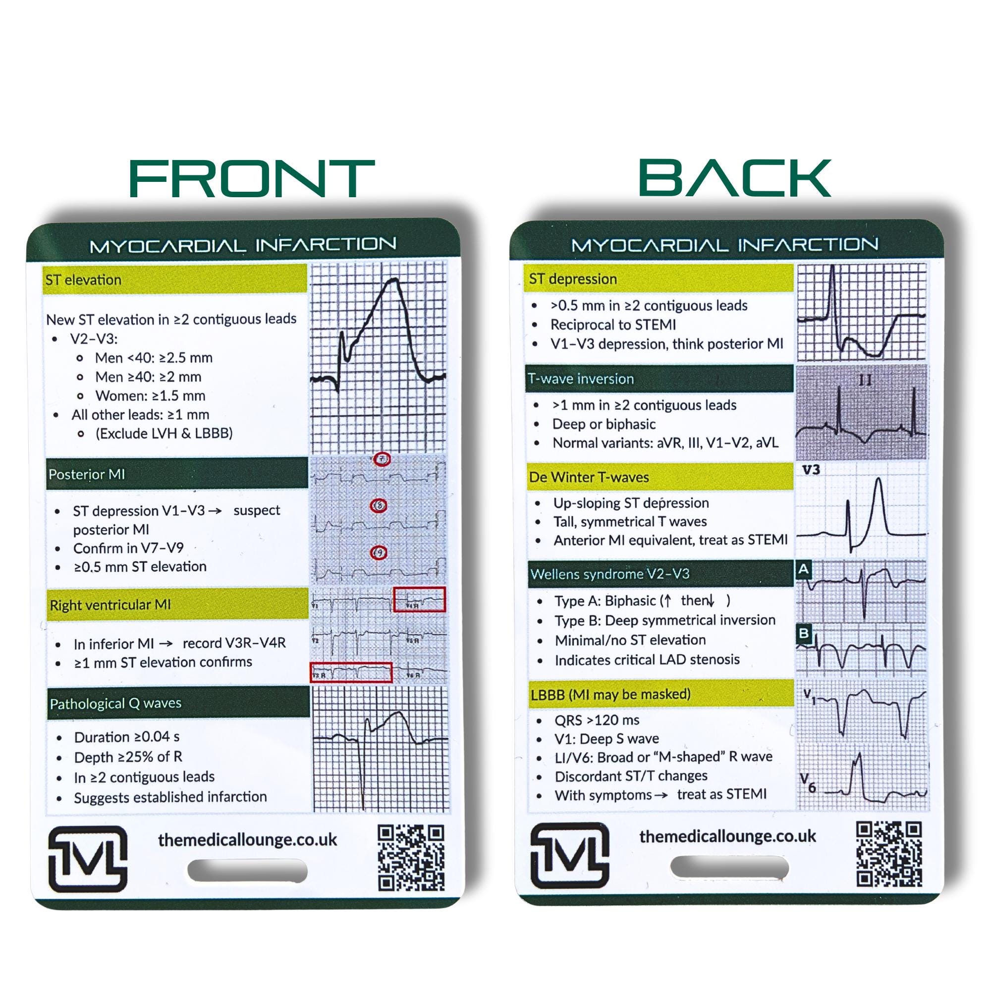 Myocardial Infarction (stemi) Ecg Reference Card - Etsy UK