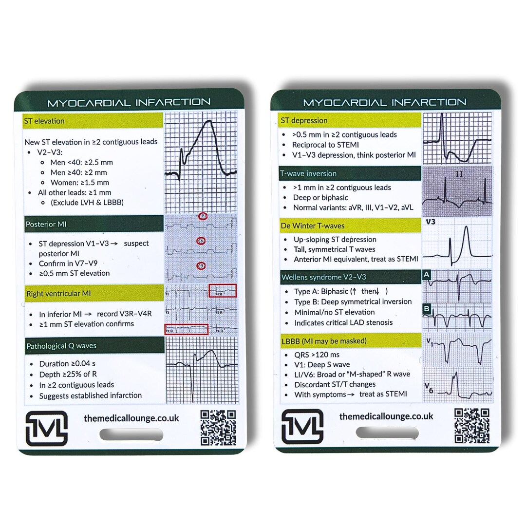 Myocardial Infarction Ecg Reference Card | Ecg Study & Revision Aid for ...