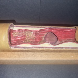 May include: A cross-section model of a blood vessel, showcasing a blockage. The vessel's interior is painted red, with a tan outer layer. A large, dark mass represents a clot, and other areas show plaque buildup. The model is mounted on a wooden base.