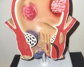 Model of rectum with diseases