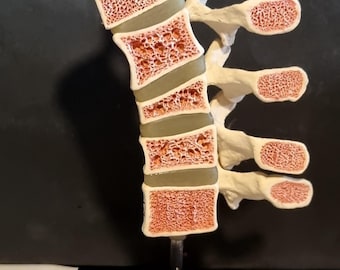 Modell av ett ryggradssegment i längdsnitt som visar skador på ryggraden.