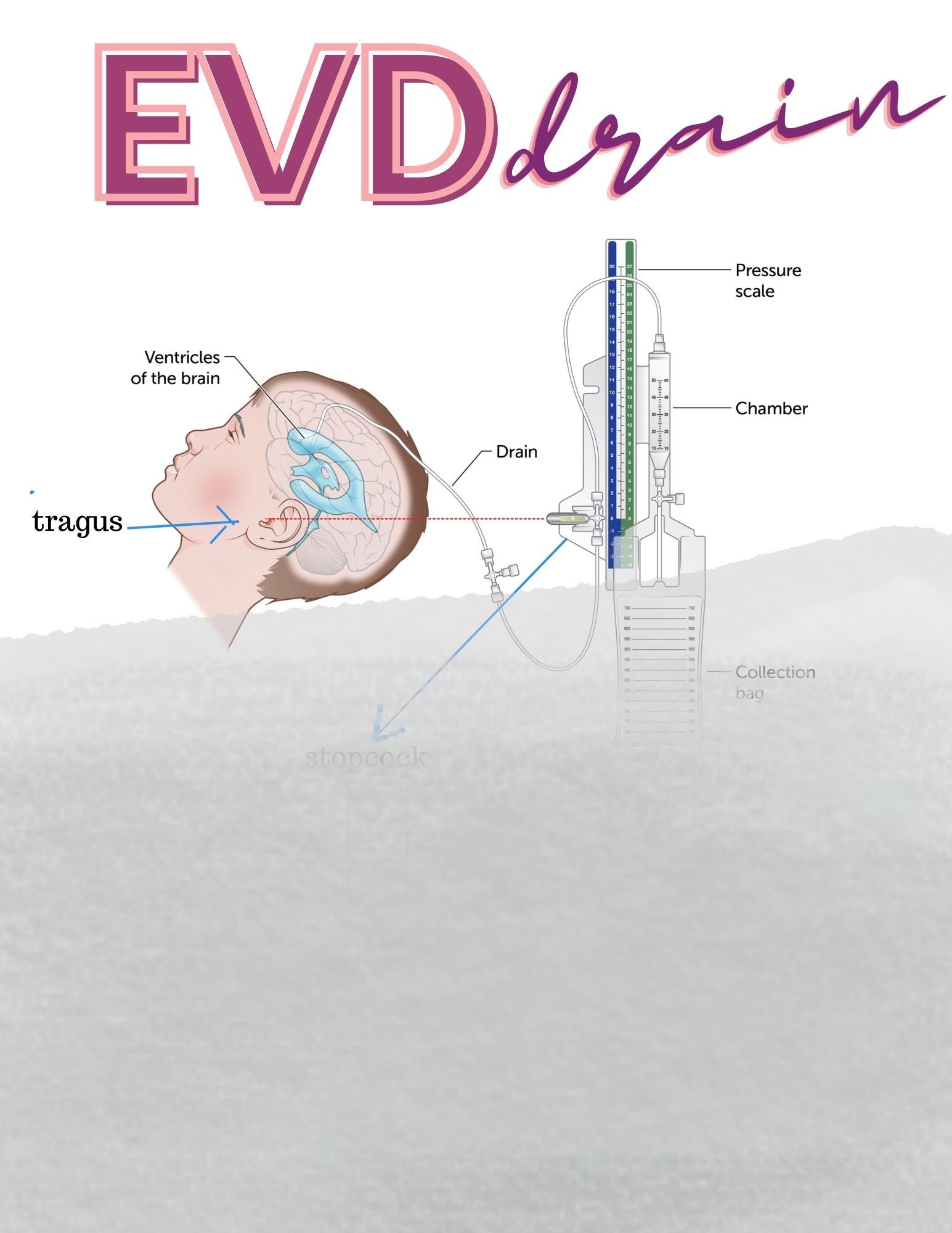 EVD Drain Care For Monitoring And What Numbers Are Important ICU EVD Drain Care For Monitoring And What Numbers Are Important ICU