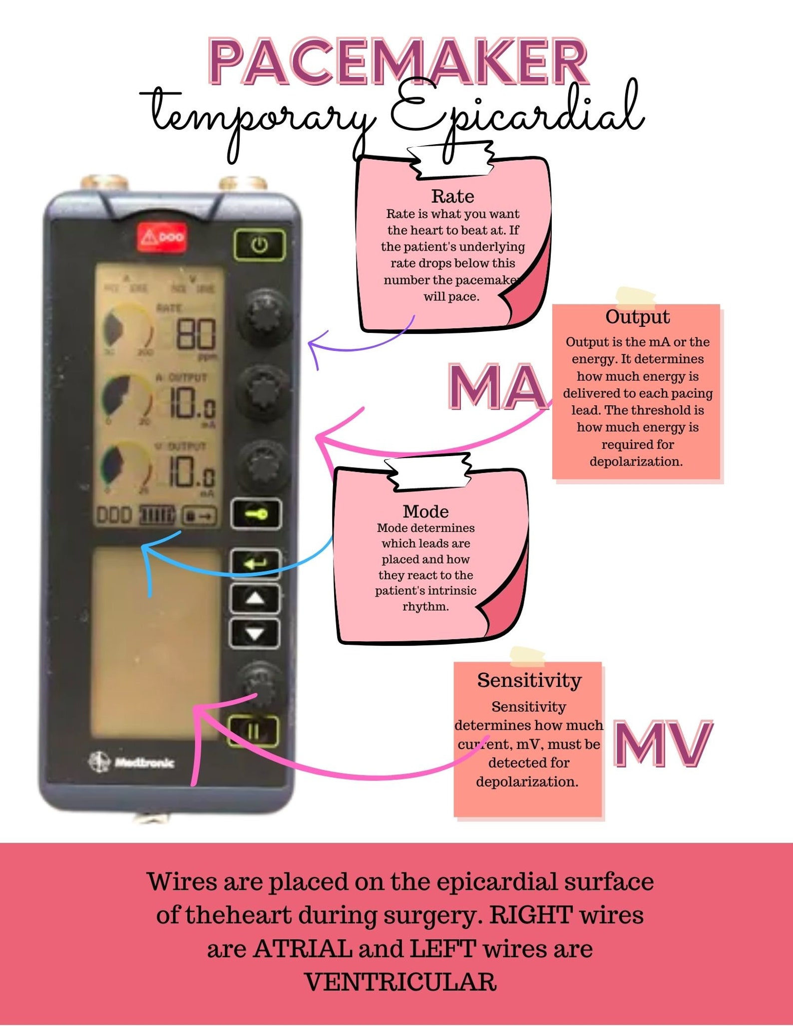 Pacemaker Cheat Sheet: ICU Nursing Notes (PDF Download) - Etsy