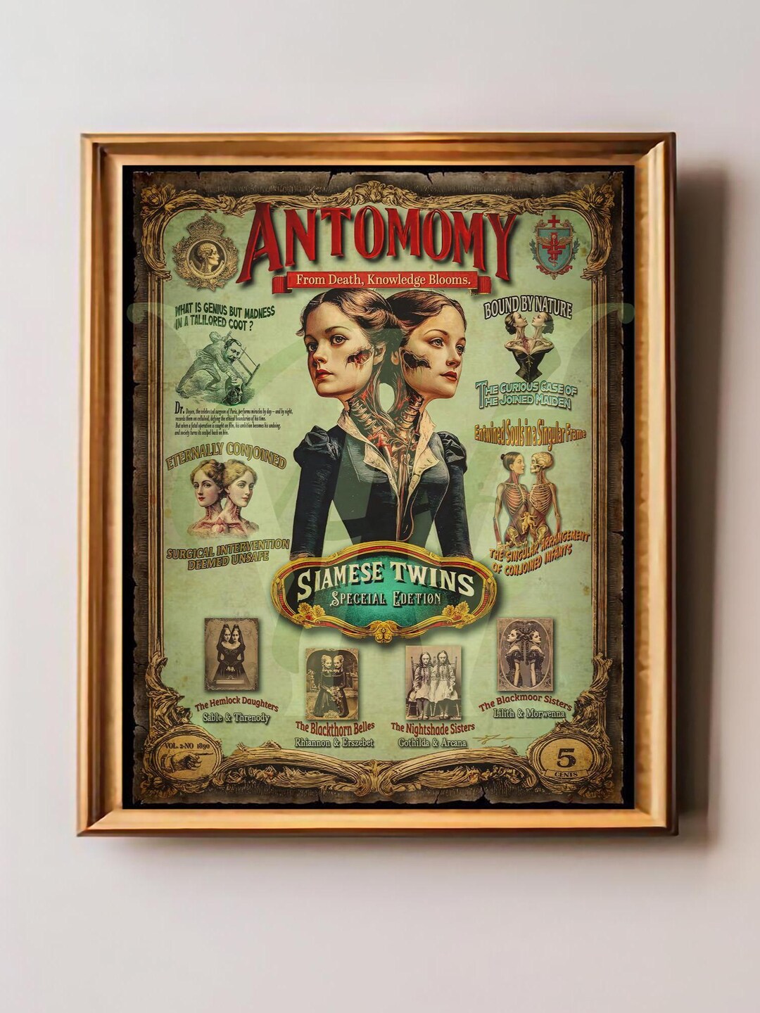 Siamese Twins Anatomical Print: Vintage Medical Curiosity Art - Etsy