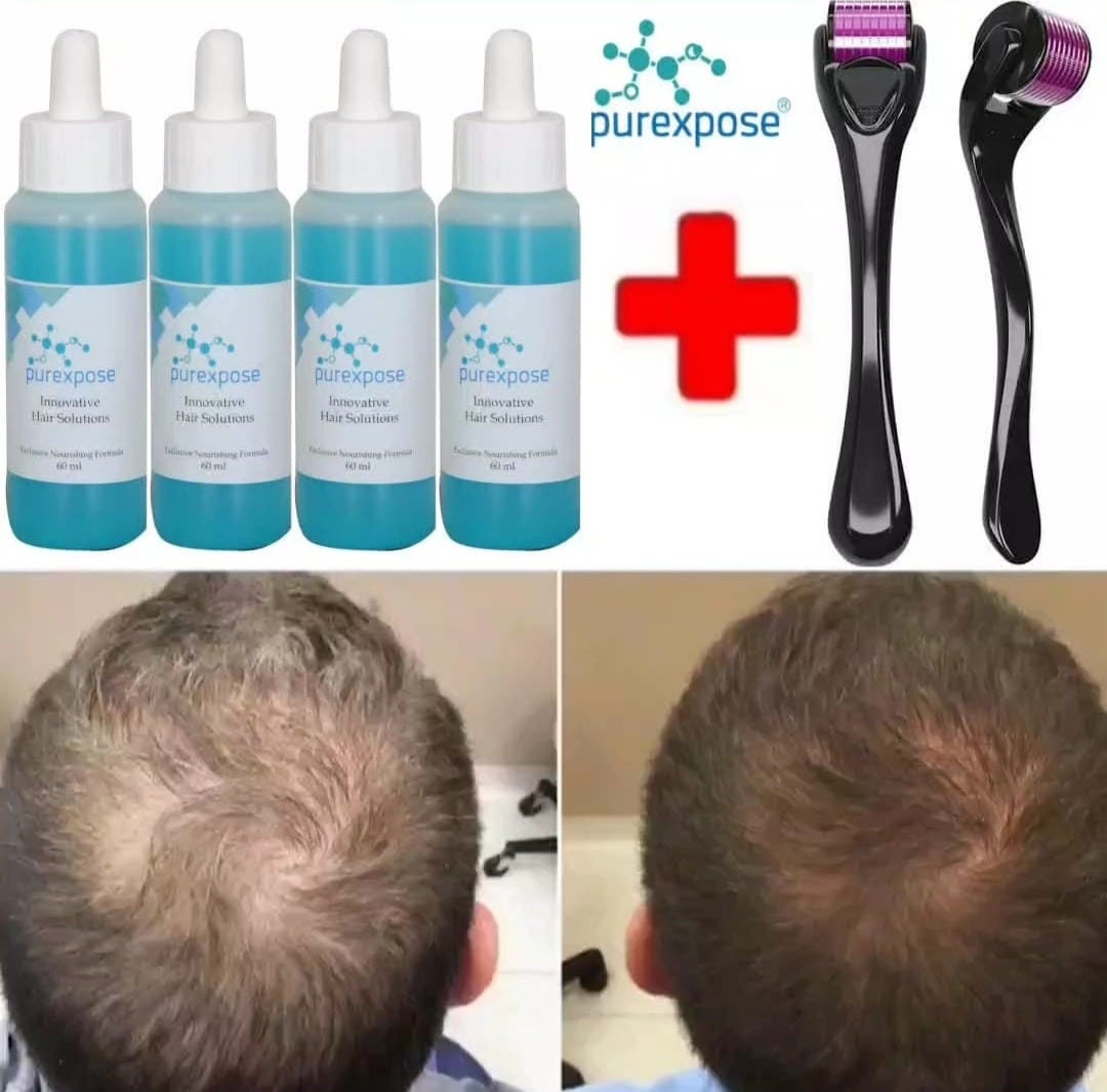 Baldness Cure 2025 Joann Lyndsey