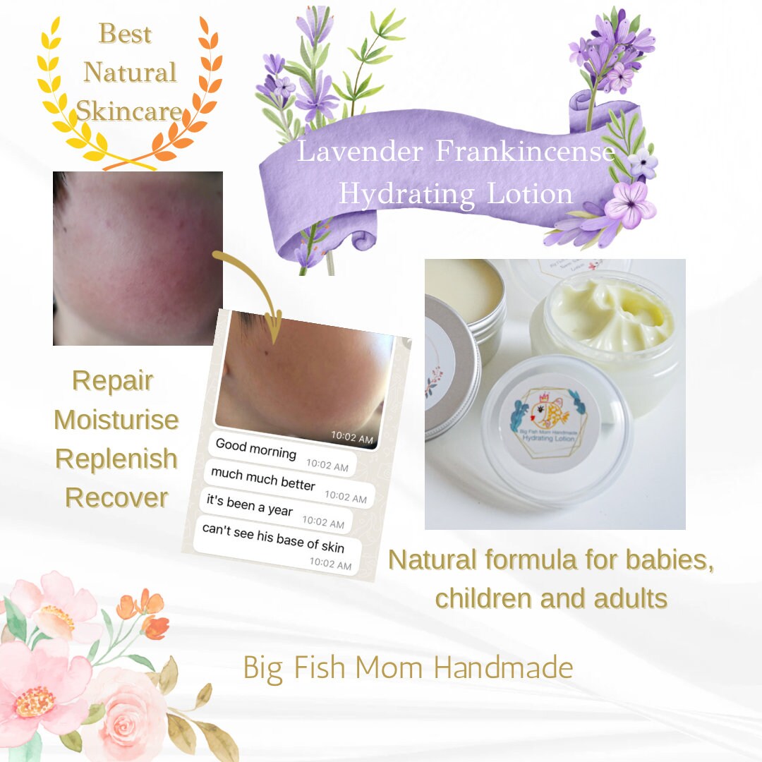 Lavender Frankincense Hydrating Lotion Eczema Cream Eczema Lotion Acne