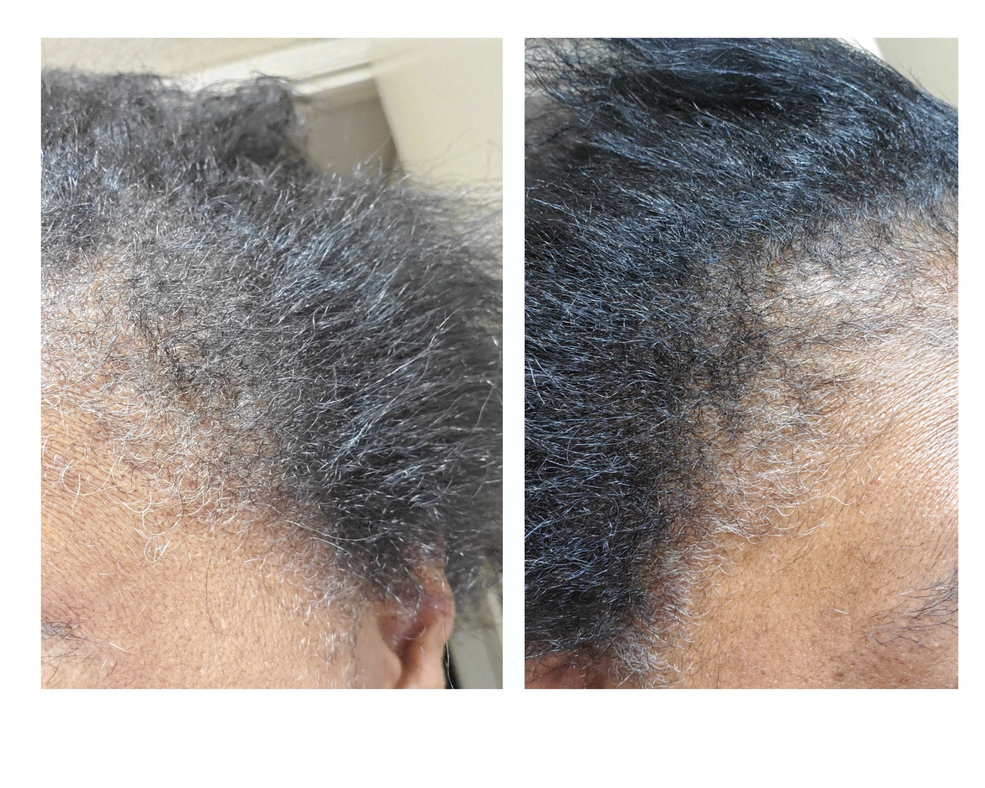 Rosemary & Mint Hair Growth Oil, Receding Hair Line, 4c Hair Growth