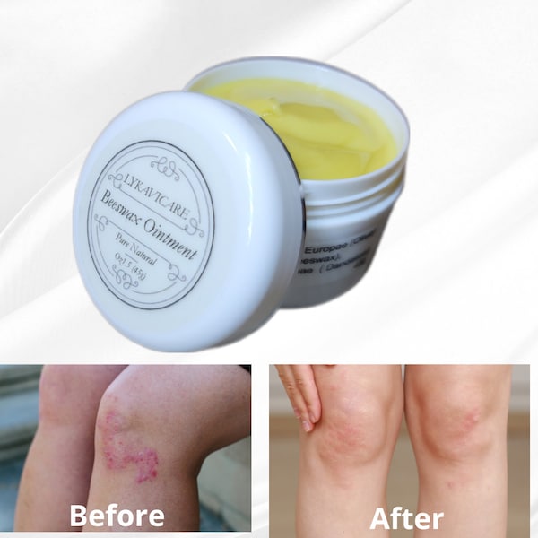 Beeswax Ointment, Psoriasis cream, Psoriasis relief,  Eczema relief, Natural Cream for Dry Skin, Fast Absorbing, Skin Care Cream,