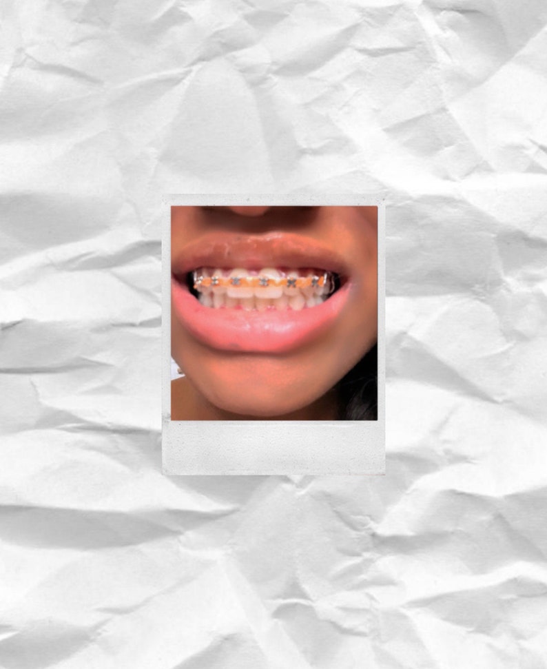 Fake aesthetic braces, fashion braces, teeth gem, fake braces image 3