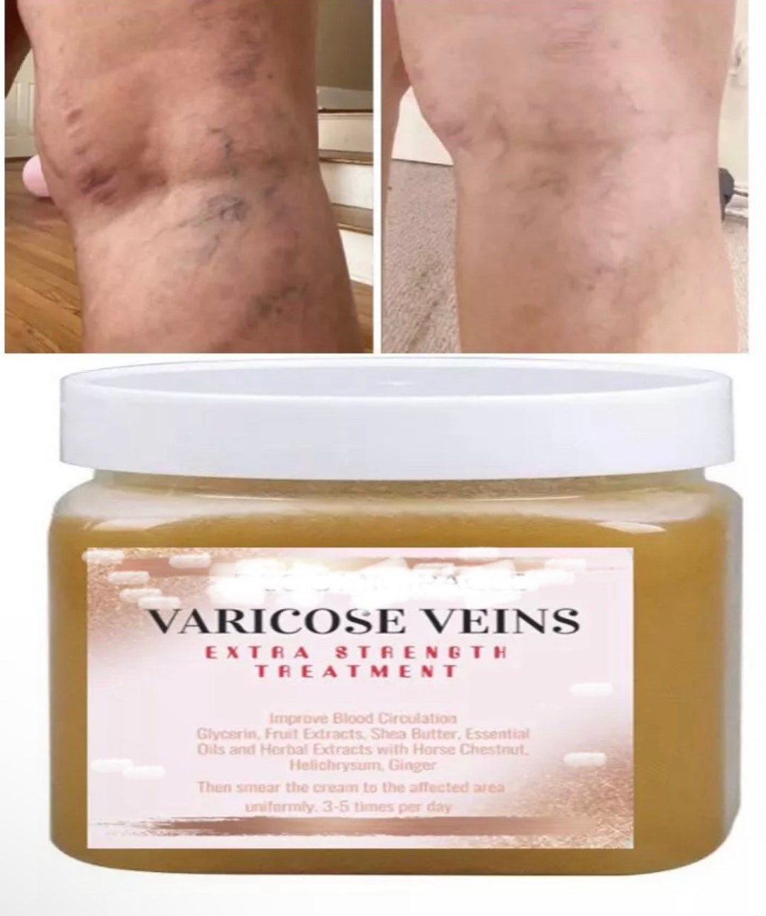 Varicose Veins Remover Extra Strength Etsy