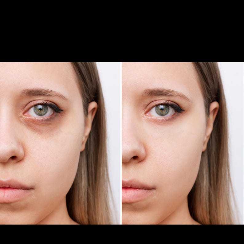 Pu&ograve; includere: Immagine divisa in due parti che mostra il volto di una donna. Un lato presenta occhiaie scure, l'altro lato una carnagione pi&ugrave; chiara. La donna ha occhi verdi e capelli castano chiaro. Confronto prima e dopo.