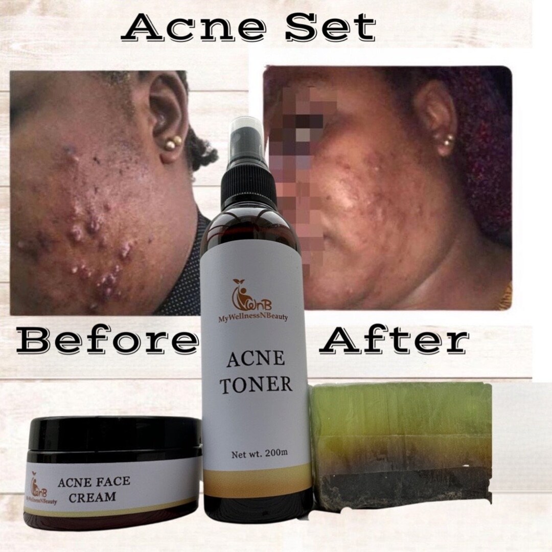 Acne Set Spots & Pimples Bar Soap Acne Facial Cleanser Etsy