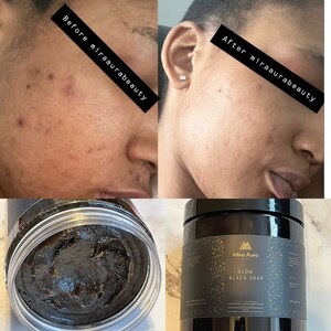 Puede incluir: Fotos de antes y después de la cara de una persona que muestran los resultados del uso de un jabón negro. El producto se muestra en un frasco negro con letras doradas que dicen "Mira Aura Glow Black Soap".