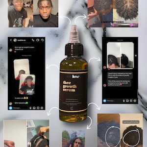 Zeeluxe Hair Growth Oil, made with batana, rosemary, pumpkin seed, amla , castor, and more… For Bald spots, alopecia, hair loss and thinning