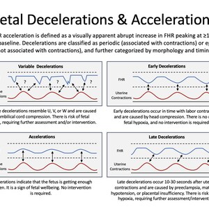 May include: A medical diagram titled "Fetal Decelerations & Accelerations" displays graphs illustrating fetal heart rate patterns. The image includes descriptions of variable, early, late decelerations, and accelerations, with explanations of their causes and implications.