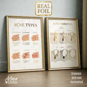May include: Two framed posters with gold frames. The left poster is titled "ACNE TYPES" and illustrates different types of acne. The right poster, "ACNE FORMATION," shows the process of acne development. The top right corner has a gold foil label that says "REAL FOIL."