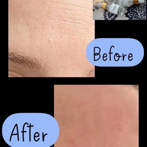 K&ouml;nnte beinhalten: Vorher-Nachher-Fotos, die die Ergebnisse der Anwendung von Bluebird Serum zeigen. Das Vorher-Foto zeigt Falten auf der Stirn. Das Nachher-Foto zeigt glattere Haut.