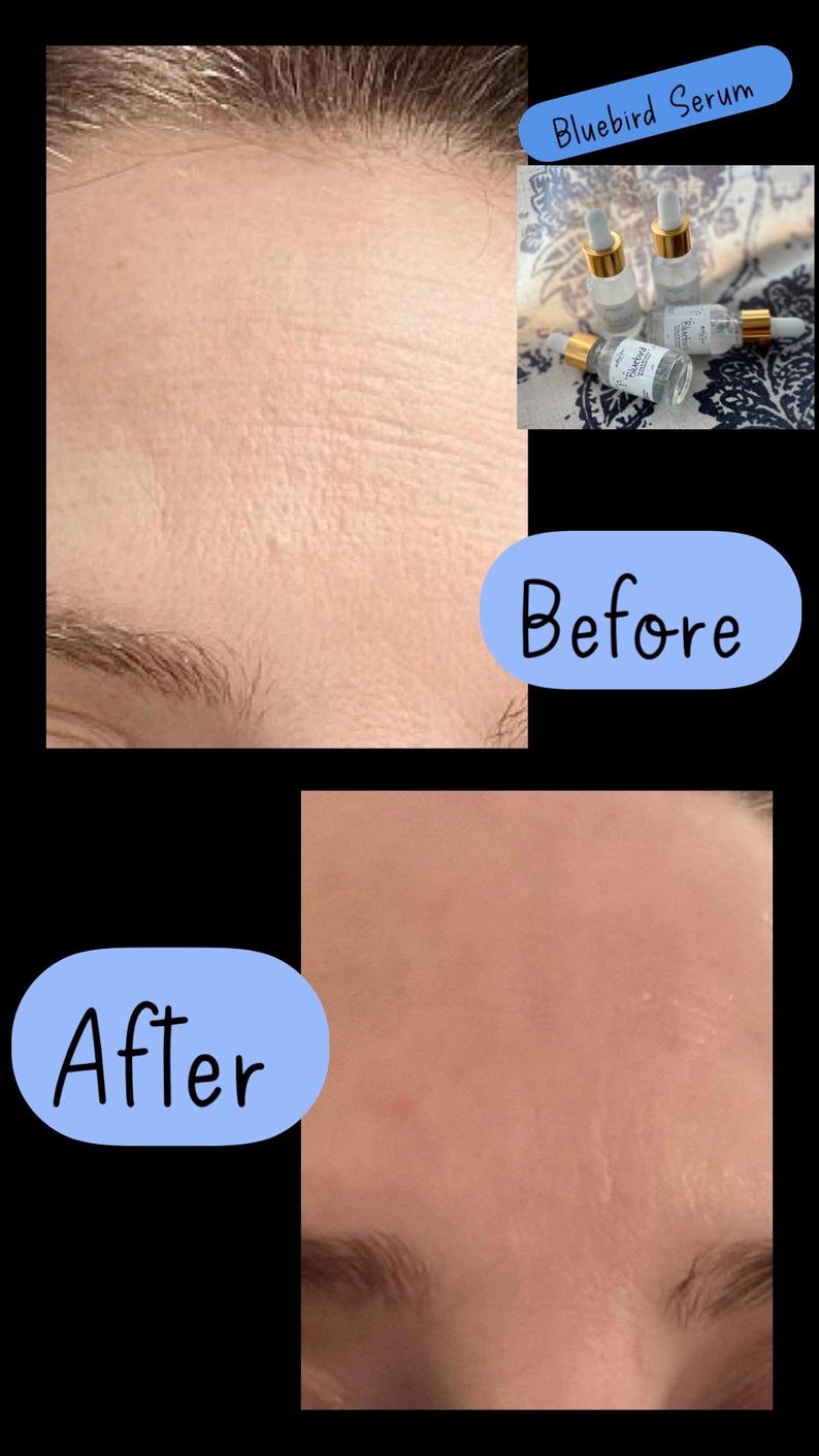K&ouml;nnte beinhalten: Vorher-Nachher-Fotos, die die Ergebnisse der Anwendung von Bluebird Serum zeigen. Das Vorher-Foto zeigt Falten auf der Stirn. Das Nachher-Foto zeigt glattere Haut.