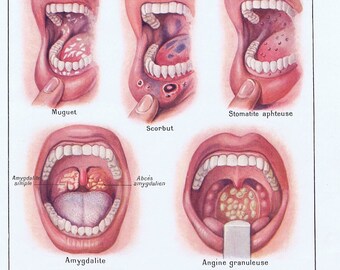 1925, Mond, Mondziekten, Tanden, Lichaam, Antieke Anatomie Prent, Larousse Medical