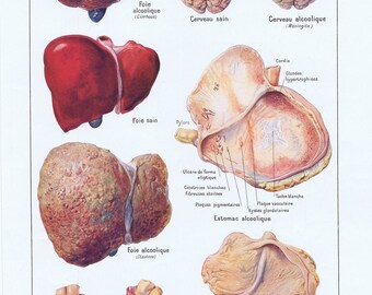 1925, Alkoholismus, Hebel, Hersenen, Lichaam, Antieke Anatomie Prent, Larousse Medical