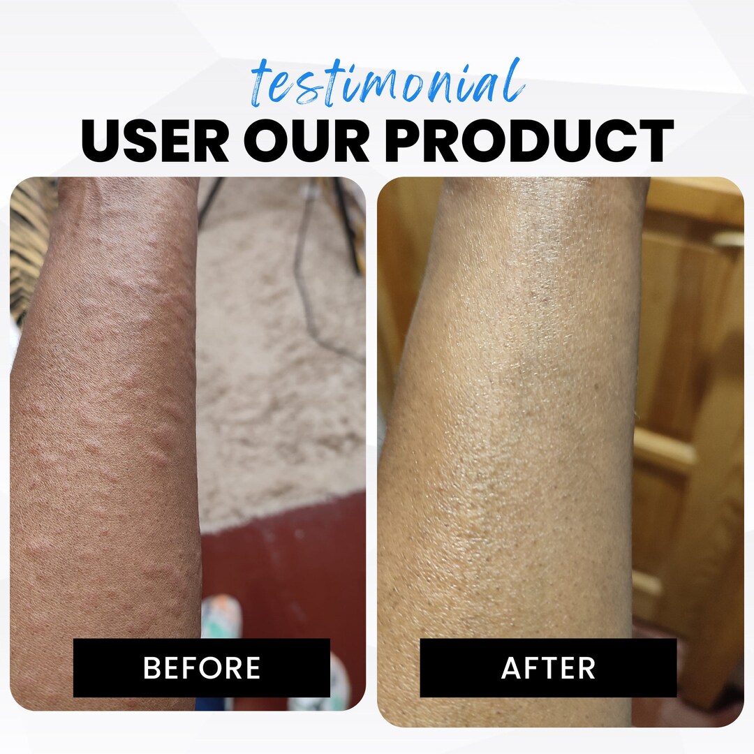 Organic Eczema Cream, Face and Body Cream, Children Eczema Cream, Adult