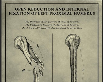 Descarga digital 18” x 12” - “Reducción abierta y fijación interna del húmero proximal izquierdo” por Quatzu