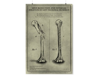 Unframed Print - “Open Reduction and Internal Fixation of Left Proximal Humerus” by Quatzu