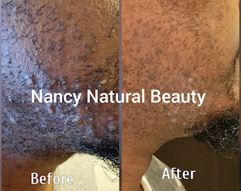 Razor Bump Stopper Cream: Natural Skin Treatment