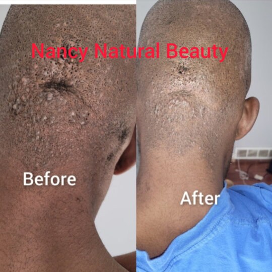 Razor Bump Stopper Cream: Natural Skin Treatment - Etsy