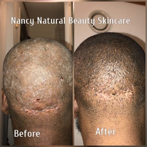 May include: Before and after photos showing the results of a skincare treatment. The before photo shows a person's scalp with visible scarring and redness. The after photo shows the same area of the scalp with less scarring and redness. The text "Nancy Natural Beauty Skincare" is at the top of the image. The text "Before" is below the left photo and the text "After" is below the right photo.