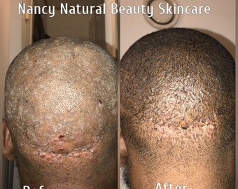 Natürlicher Rasiermesserkratzer & eingewachsenes Anti-Juckreiz-Öl