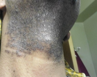 Natural Razor Bumps & Ingrown Hair Acne Treatment (Dark Beard Marks Remover)