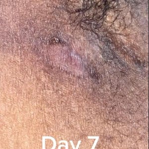 May include: Close-up of a healed scar on dark skin. The scar is light pink and white. The text "Day 7 Fully healed!" is visible below the scar.