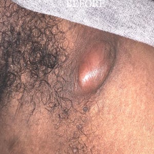 Puede incluir: Primer plano de una protuberancia grande, redonda y de color carne en la piel de una persona.