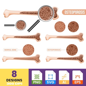 May include: An illustration comparing normal bone and osteoporosis. The image shows bone cross-sections, magnified views, and the text "Osteoporosis" and "Normal Bone". The image also includes file type icons and the text "8 Designs 300 DPI".