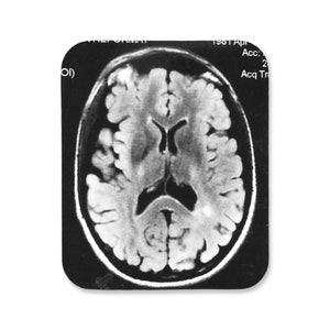 May include: Black and white MRI scan of a human brain. The image shows a cross-section of the brain, with the different parts of the brain clearly visible.