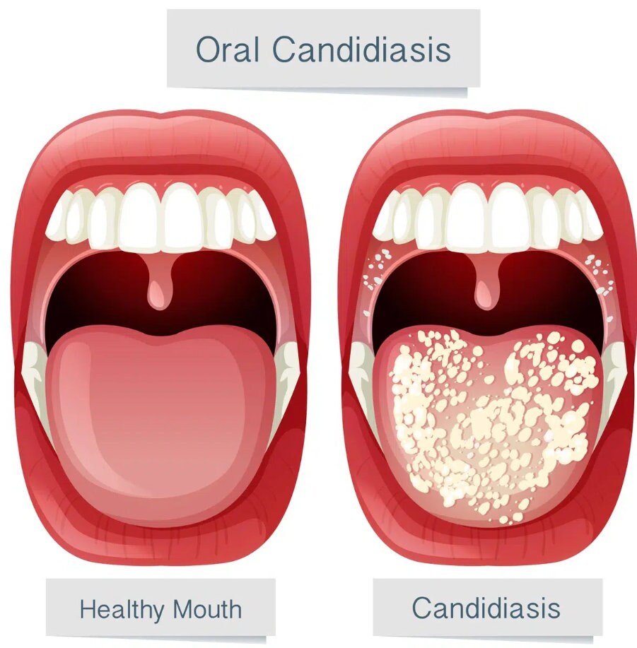 Daktarin Antifungal Oral Gel for Bacterial Infections of the Mouth & Throat, Canker Sores