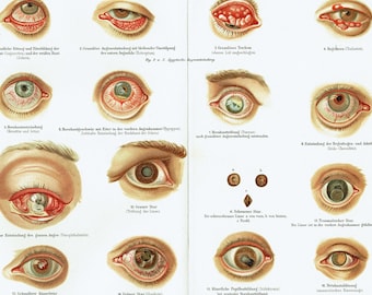 1893 Antique Lithograph of Eye Diseases Vintage Medical Wall Art, Ophthalmology Studies, Anatomical Gallery Wall