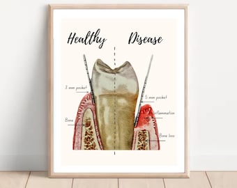 Gum Disease Anatomy Poster: Dental Office Art