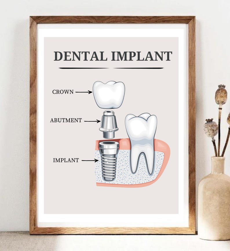 Dental Implant Education Poster, Dental Patient Procedure Art, Dental