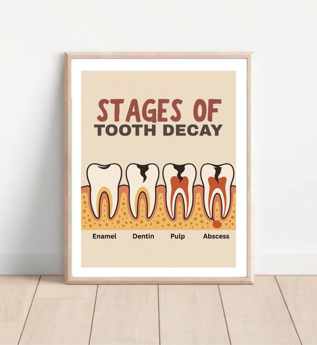 Stages of Tooth Decay Poster - Dental Education Wall Art - Eye-catching ...