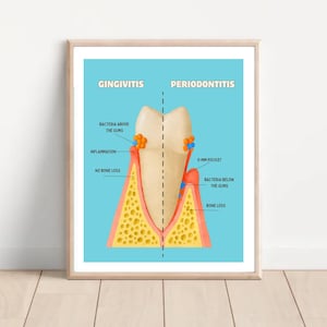 Gingivitis vs Peridottal Disorder Poster - Infografik Zahngesundheit - Dekorative Wandkunst