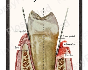 May include: A diagram comparing a healthy tooth with a tooth affected by gum disease. The healthy tooth has a 3 mm pocket, while the diseased tooth has a 5 mm pocket, inflammation, and bone loss.