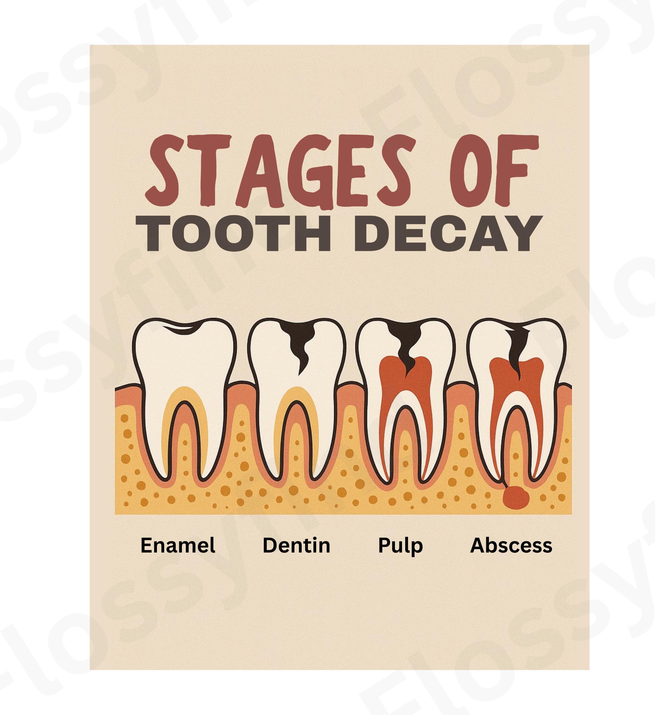 Tooth Decay Line Graph Tooth Decay Stages Print, Dental Education Caries Chart (digital ...
