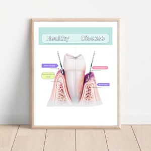 May include: A framed dental health poster. The poster shows a cross-section of a tooth, comparing a healthy tooth to a diseased tooth. The text on the poster reads "Healthy" and "Disease". The poster is in a light wood frame.