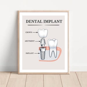 Póster educativo sobre implantes dentales, arte de procedimientos para pacientes dentales, arte mural para consultorios dentales, decoración de dentistas, póster de partes de implantes.