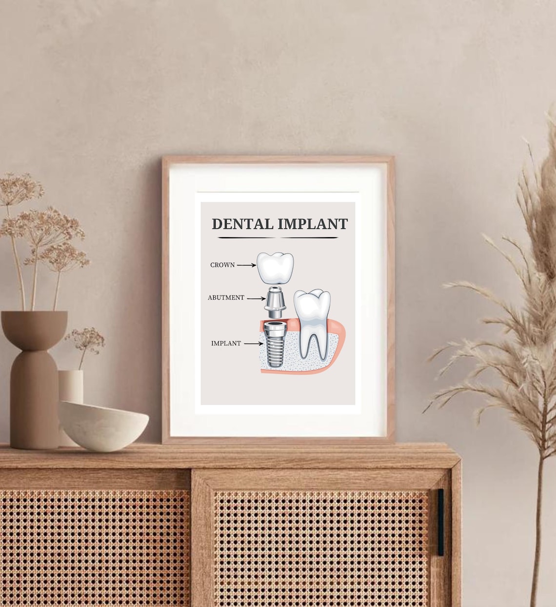 Photo inspiration: Implants Corner Decor Inspiration Reference: Dental Implant Anatomy Poster Dentist Office Decor