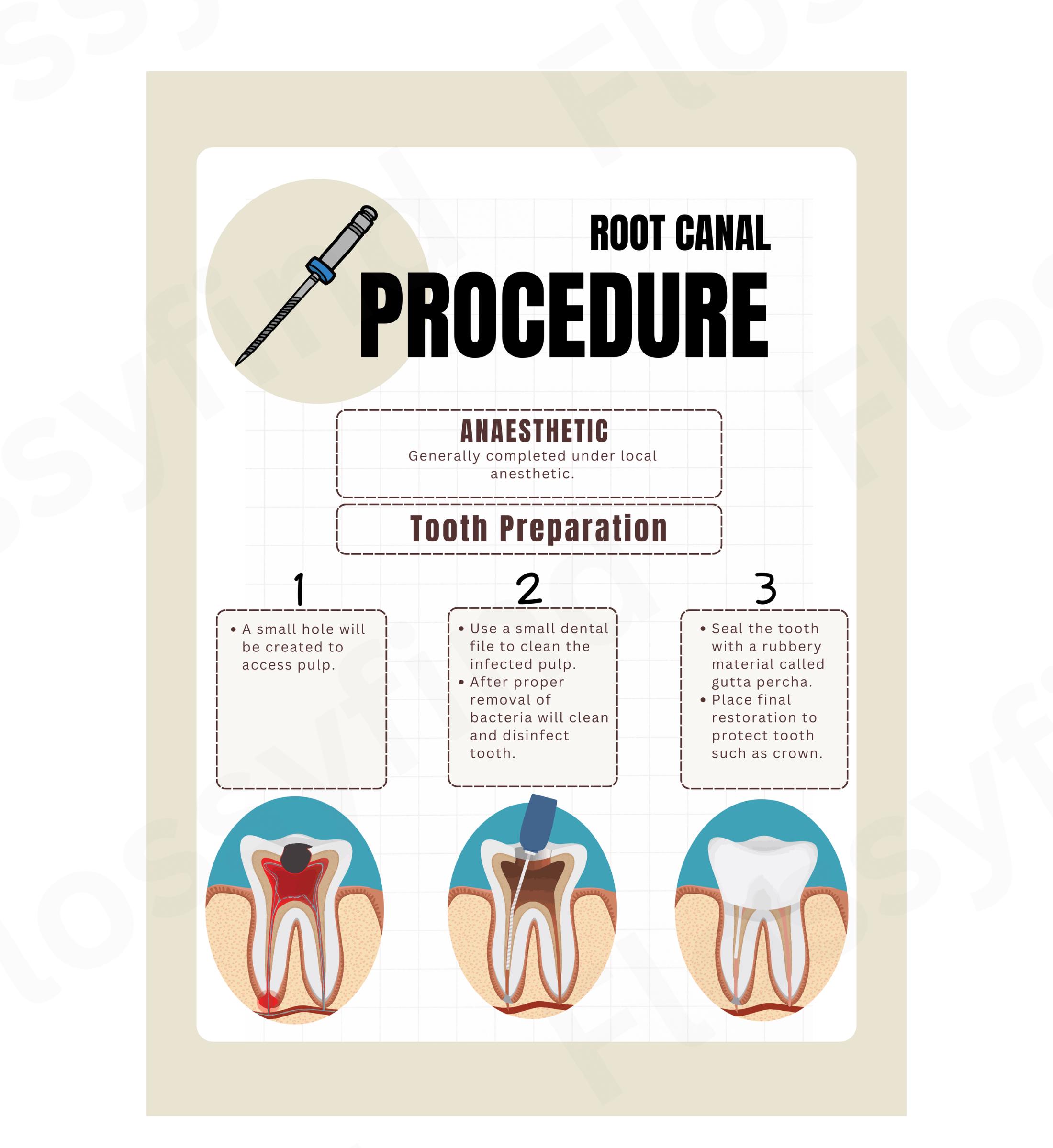 Root Canal Procedure Poster, Patient Education for Endodontist